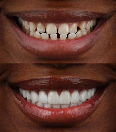 resin veneers